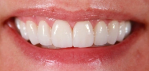 After Smile Transformation 1 - Chiu Aesthetics - Highlands Ranch, CO