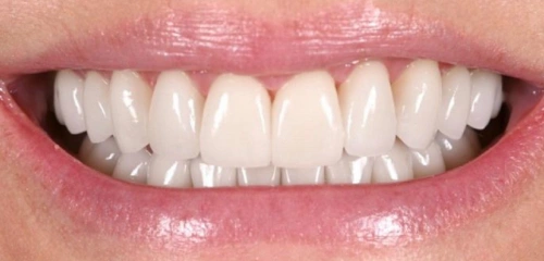 After Smile Transformation 2 - Chiu Aesthetics - Highlands Ranch, CO