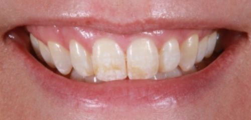 Before Smile Transformation 1 - Chiu Aesthetics - Highlands Ranch, CO