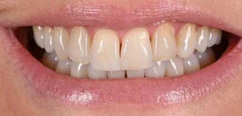 Before Smile Transformation 2 - Chiu Aesthetics - Highlands Ranch, CO