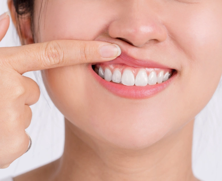 Gum Contouring in Highlands Ranch, CO - Chiu Aesthetics