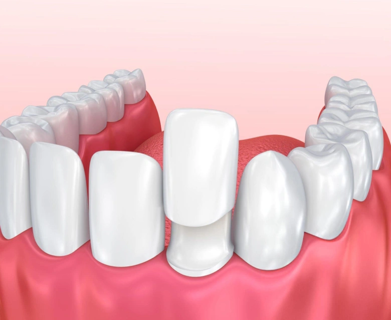 No Prep Veneers in Highlands Ranch, CO - Chiu Aesthetics