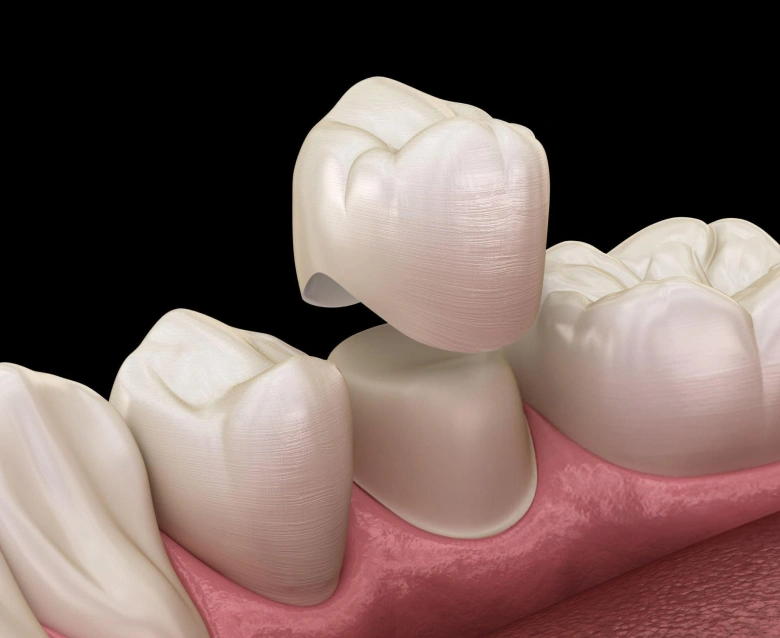 Porcelain Crowns in Highlands Ranch, CO - Chiu Aesthetics