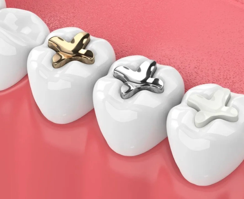 Tooth-Colored Fillings in Highlands Ranch, CO - Chiu Aesthetics