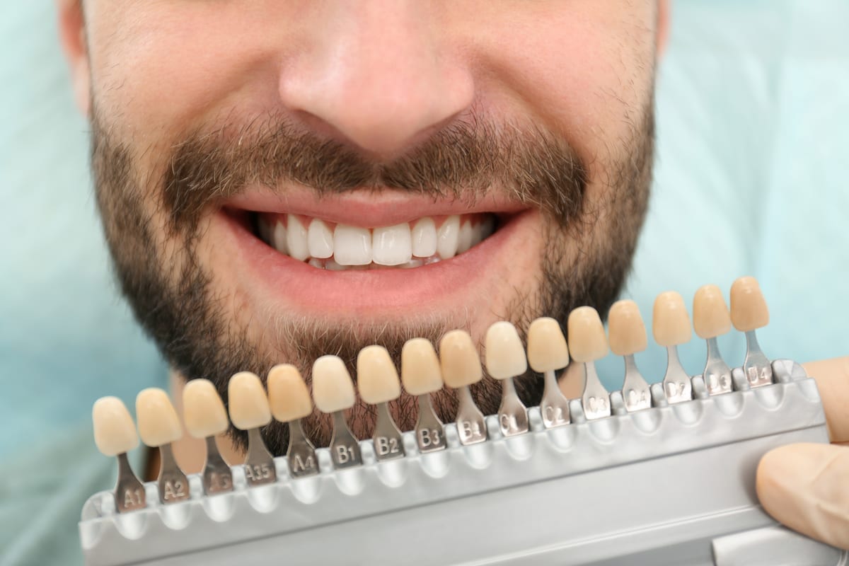 Veneers in Carriage Club